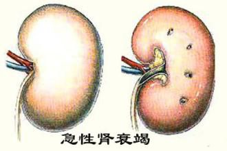 急性肾衰竭